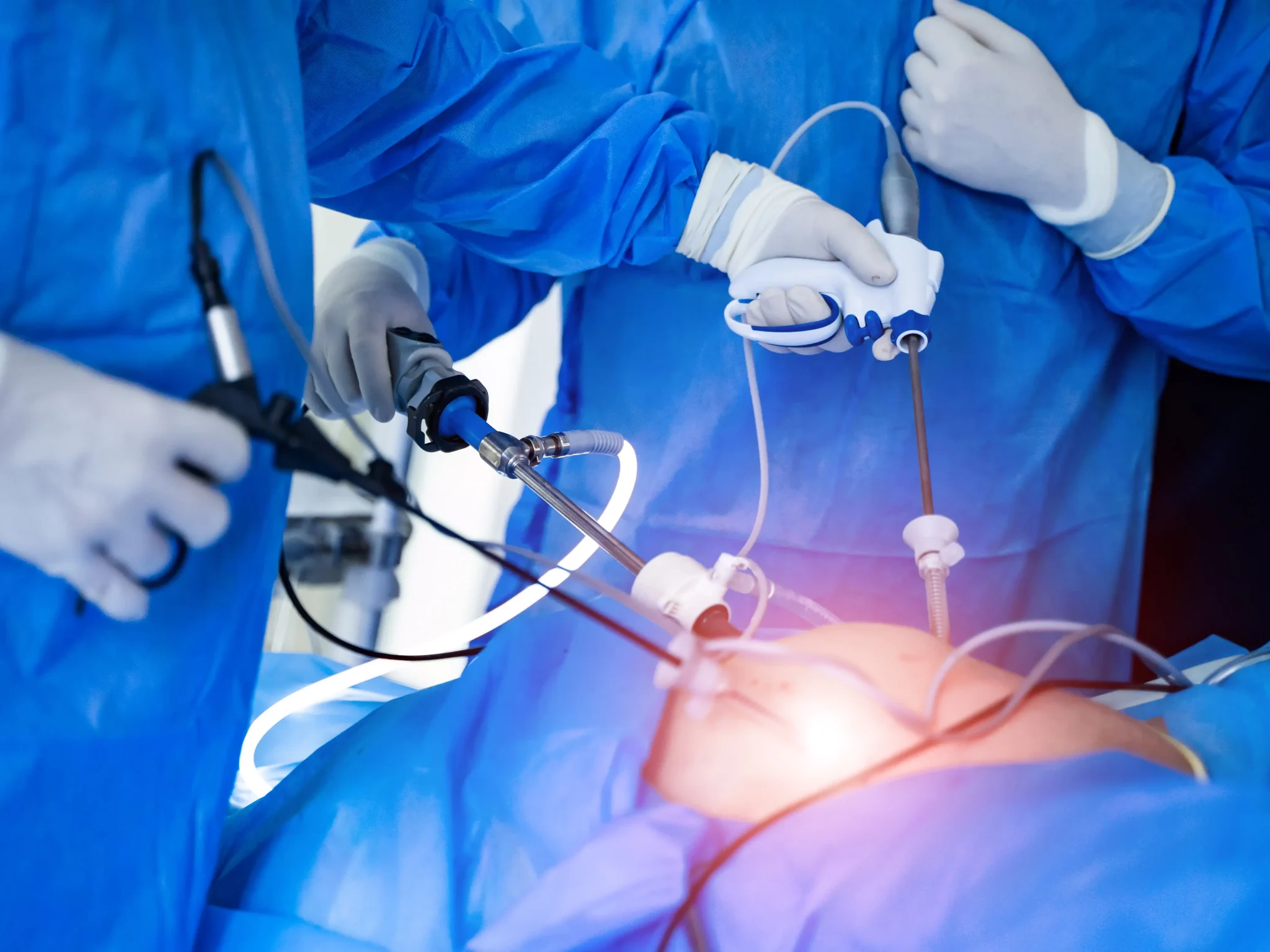 Laparoscopy